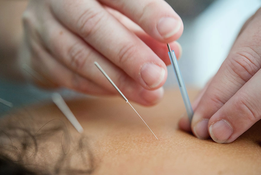 Foto di una persona che fa l'agopuntura